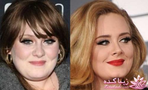 جراحی بینی - جراحی زیبایی